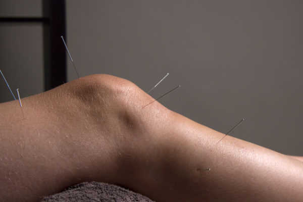 Acupuncture_London_Cupping_tuina_moxa_3